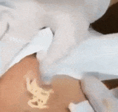 挤背部黑头视频,视频教你高效清洁技巧